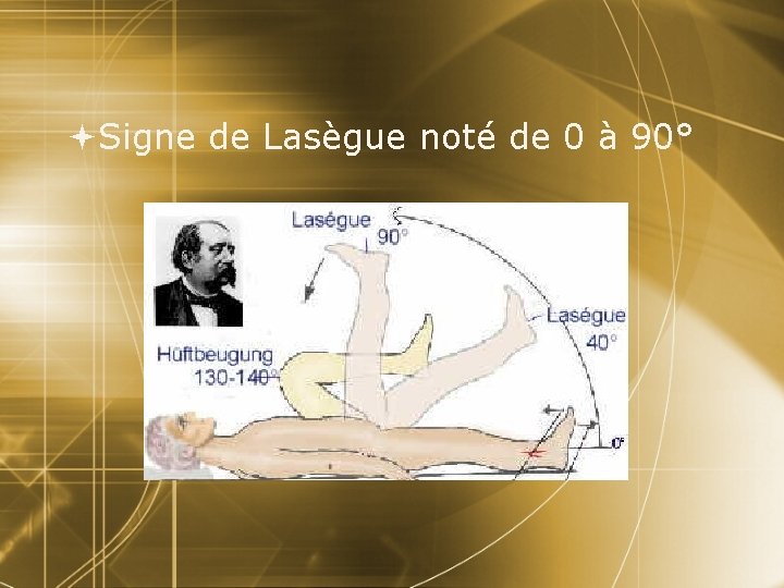  Signe de Lasègue noté de 0 à 90° 