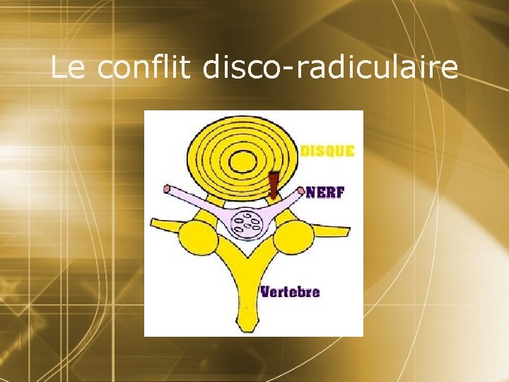 Le conflit disco-radiculaire 