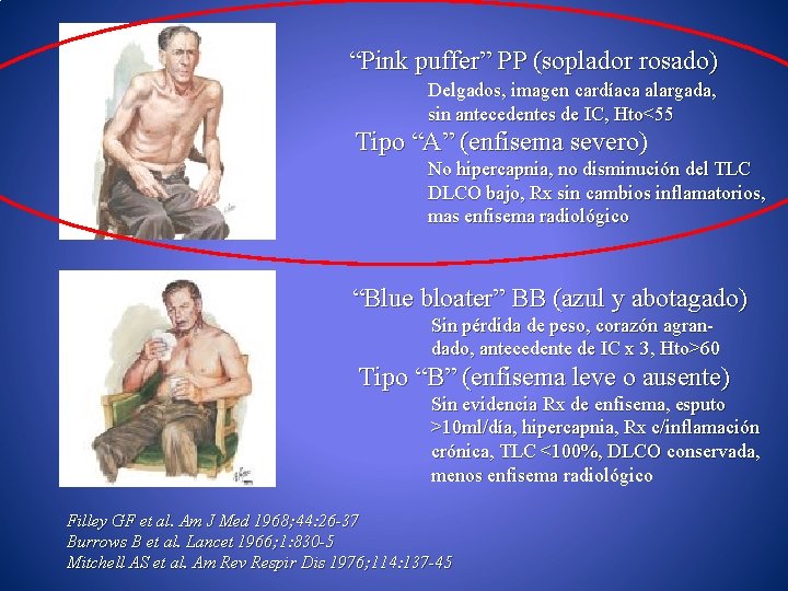 “Pink puffer” PP (soplador rosado) Delgados, imagen cardíaca alargada, sin antecedentes de IC, Hto<55