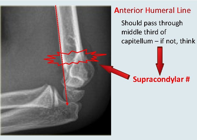 Anterior Humeral Line Should pass through middle third of capitellum – if not, think