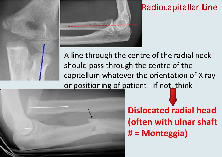 Radiocapitallar Line A line through the centre of the radial neck should pass through