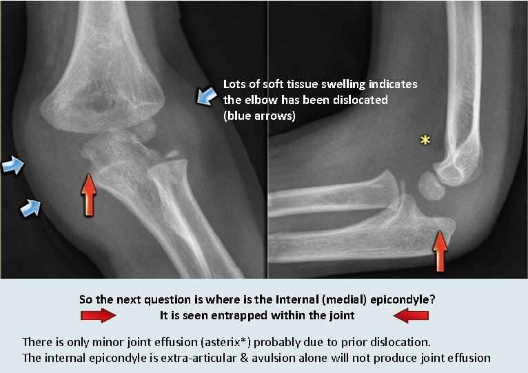 Lots of soft tissue swelling indicates the elbow has been dislocated (blue arrows) So
