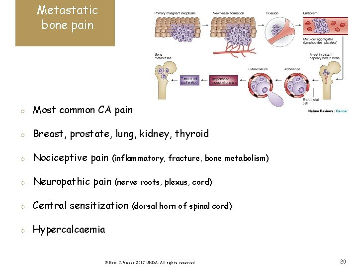 Metastatic bone pain o Most common CA pain o Breast, prostate, lung, kidney, thyroid
