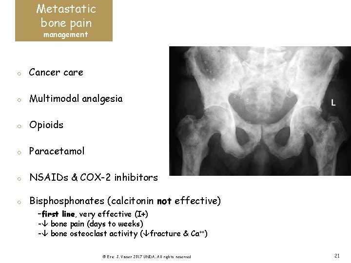 Metastatic bone pain management o Cancer care o Multimodal analgesia o Opioids o Paracetamol