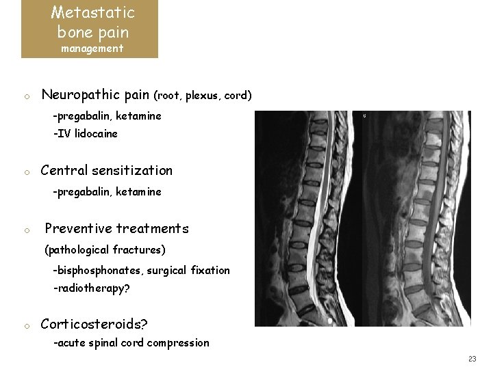 Metastatic bone pain management o Neuropathic pain (root, plexus, cord) -pregabalin, ketamine -IV lidocaine