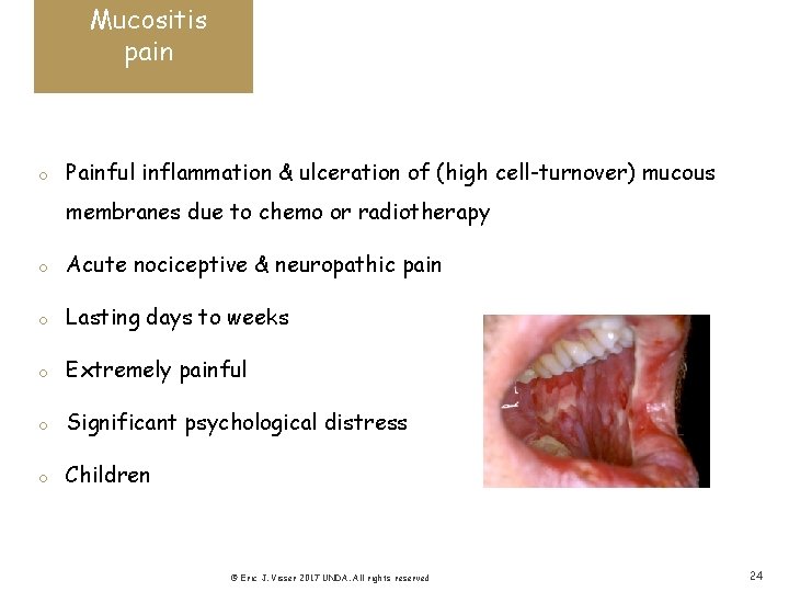 Mucositis pain o Painful inflammation & ulceration of (high cell-turnover) mucous membranes due to