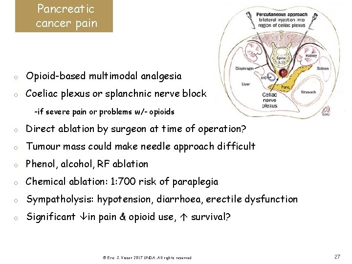 Pancreatic cancer pain o Opioid-based multimodal analgesia o Coeliac plexus or splanchnic nerve block