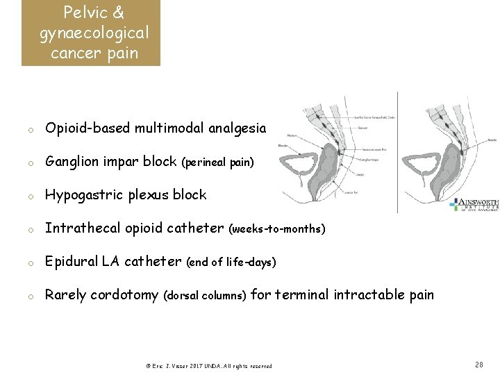 Pelvic & gynaecological cancer pain o Opioid-based multimodal analgesia o Ganglion impar block o