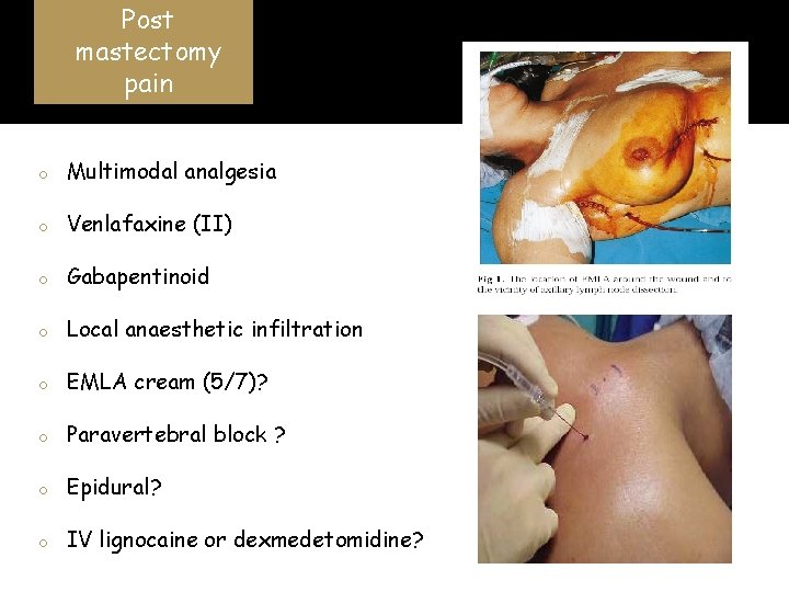 Post mastectomy pain o Multimodal analgesia o Venlafaxine (II) o Gabapentinoid o Local anaesthetic