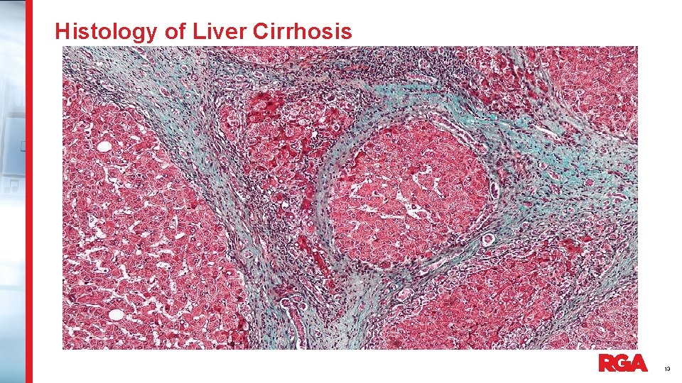 Histology of Liver Cirrhosis 13 