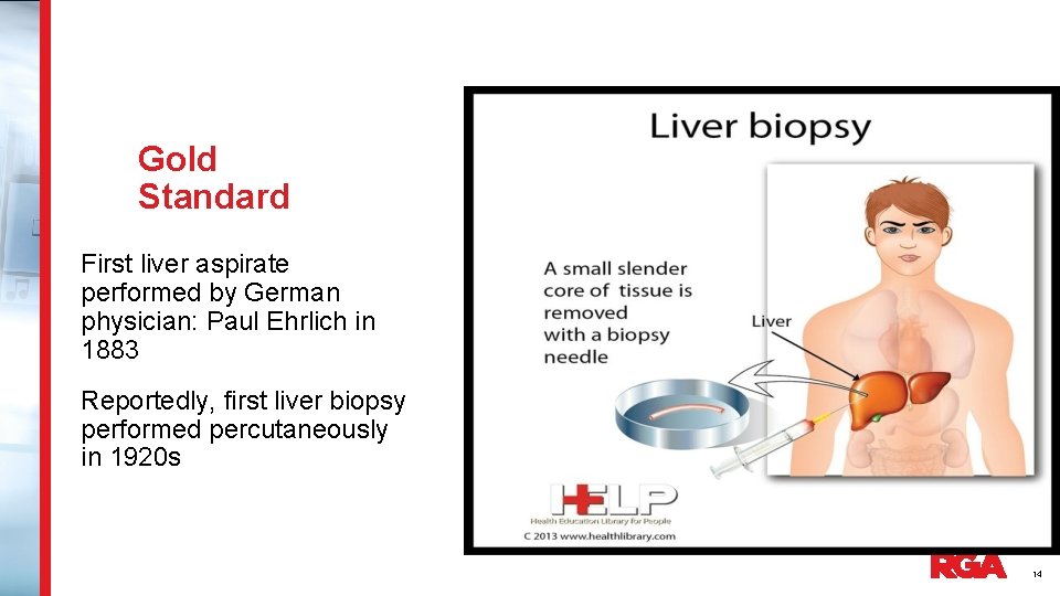 Gold Standard First liver aspirate performed by German physician: Paul Ehrlich in 1883 Reportedly,