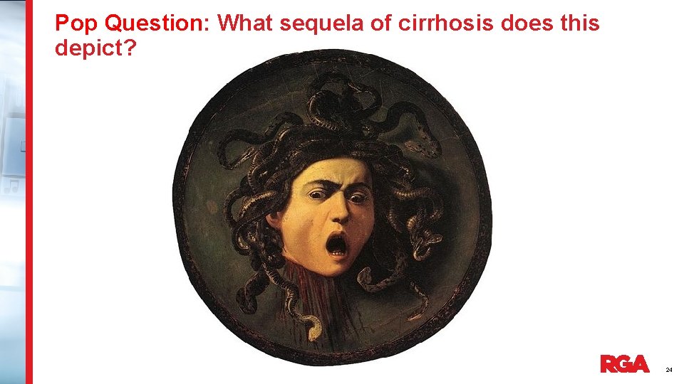 Pop Question: What sequela of cirrhosis does this depict? 24 