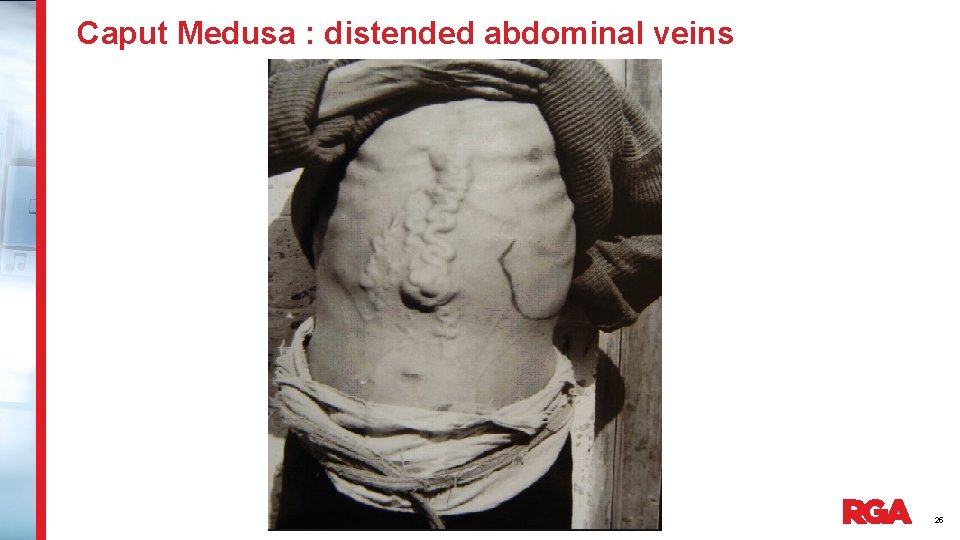 Caput Medusa : distended abdominal veins 25 