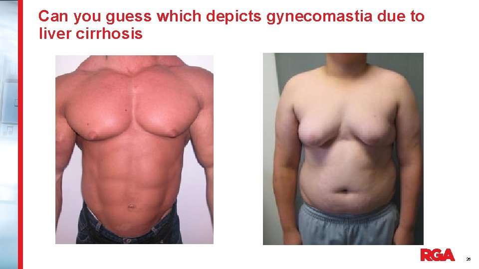 Can you guess which depicts gynecomastia due to liver cirrhosis 26 