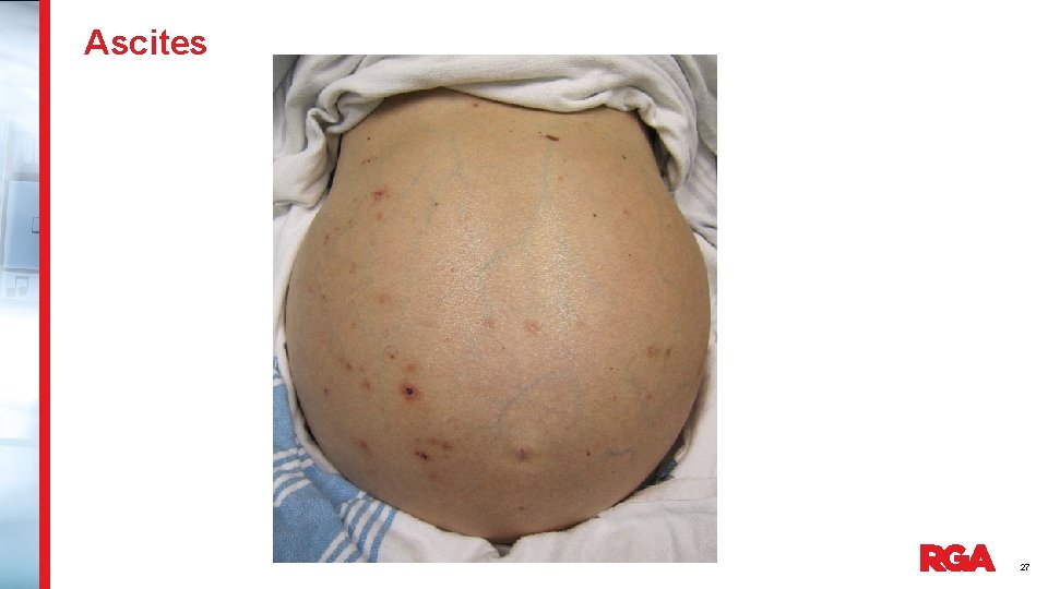 Ascites 27 