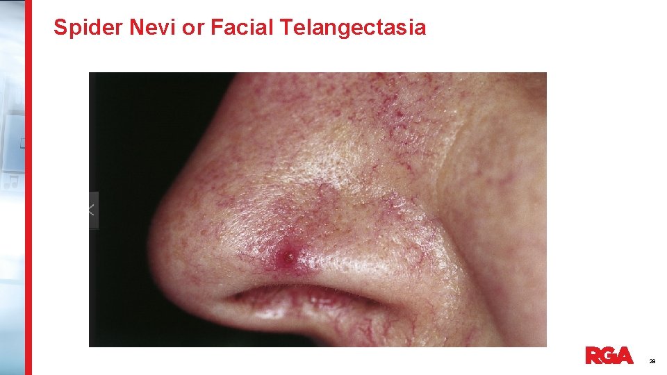 Spider Nevi or Facial Telangectasia 28 