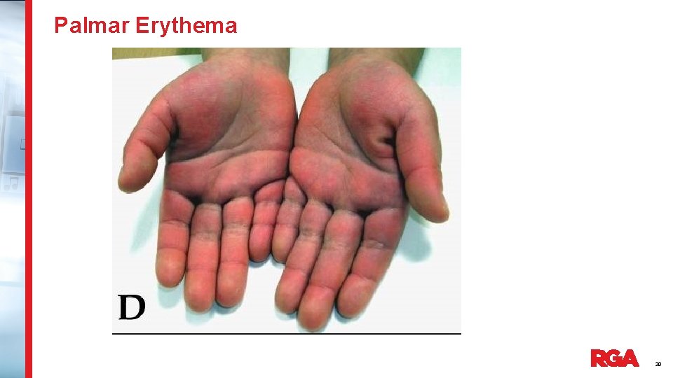Palmar Erythema 29 