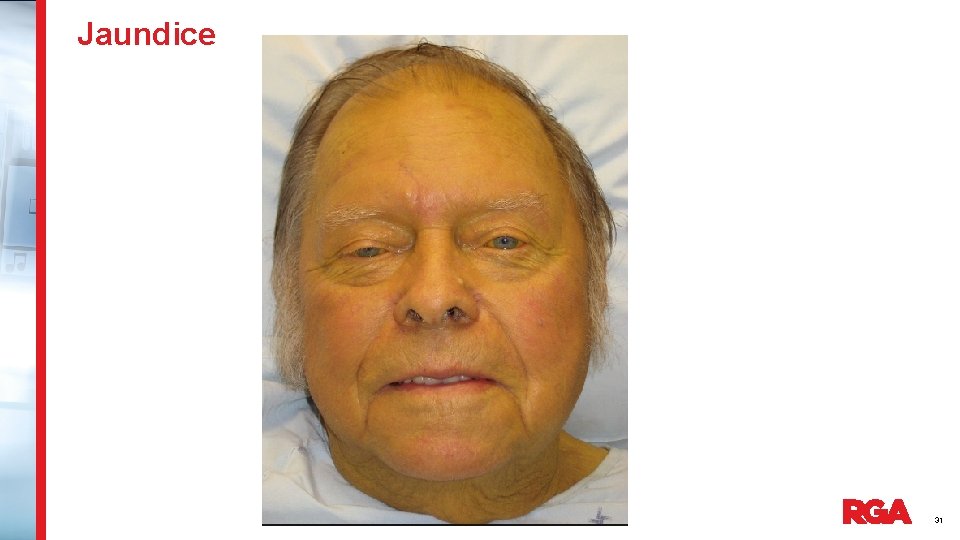 Jaundice 31 