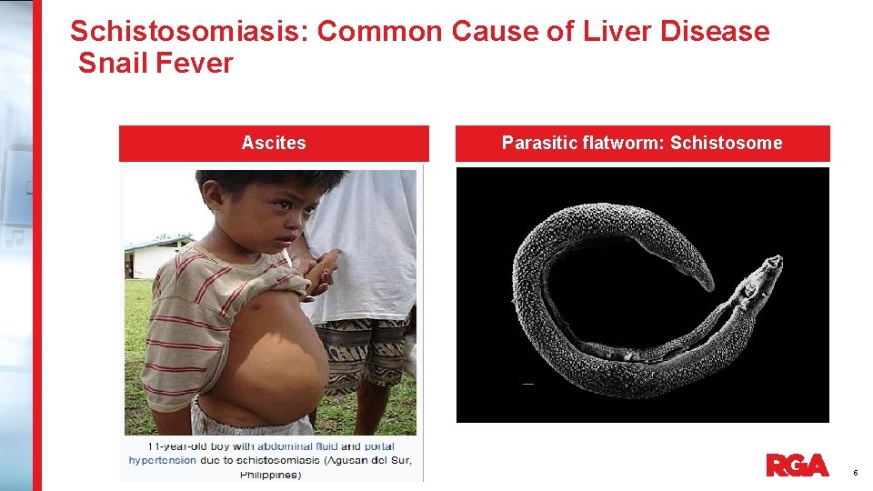 Schistosomiasis: Common Cause of Liver Disease Snail Fever Ascites Parasitic flatworm: Schistosome 5 