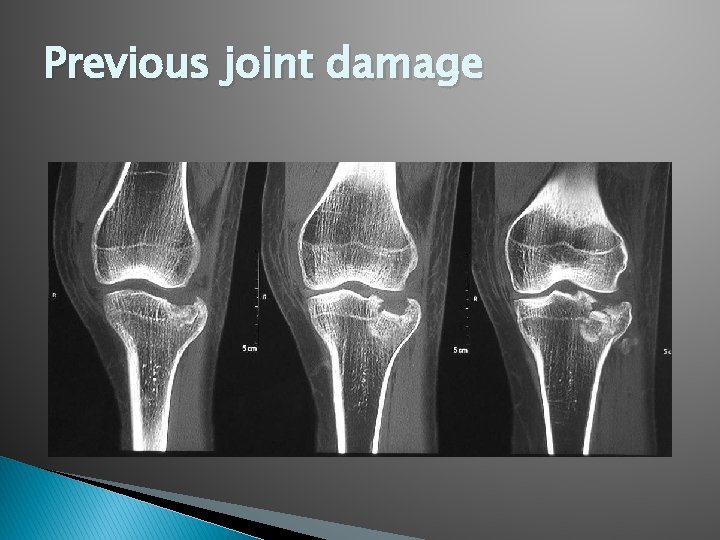 Previous joint damage 