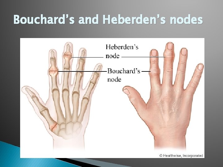 Bouchard’s and Heberden’s nodes 