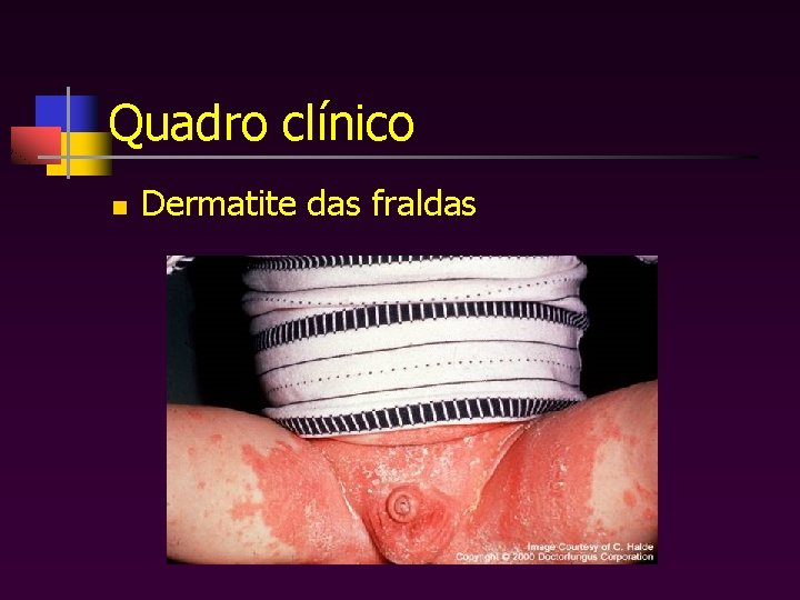 Quadro clínico n Dermatite das fraldas 