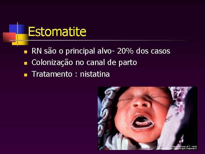 Estomatite n n n RN são o principal alvo- 20% dos casos Colonização no