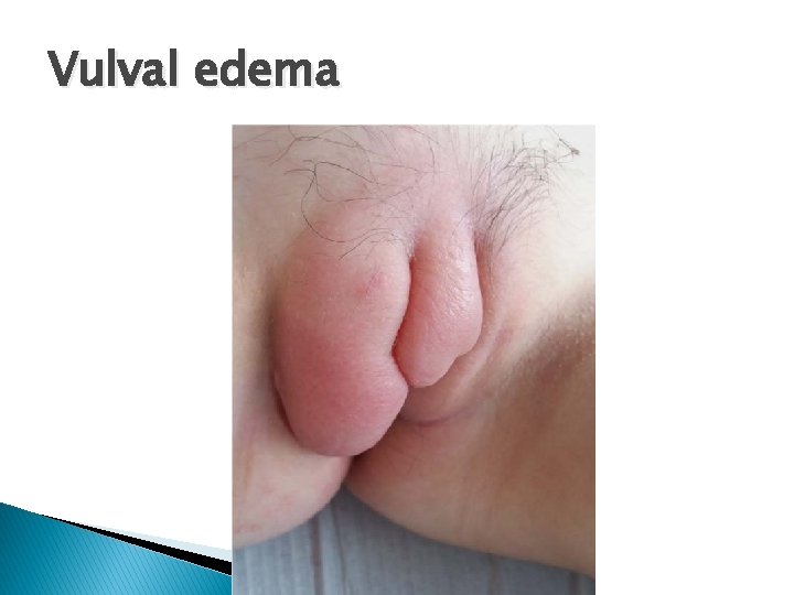 Vulval edema 