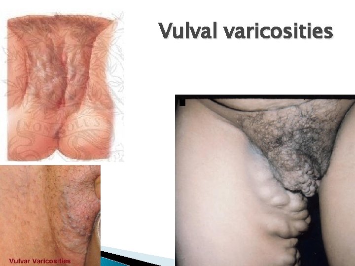 Vulval varicosities 