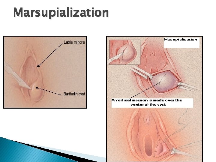 Marsupialization 