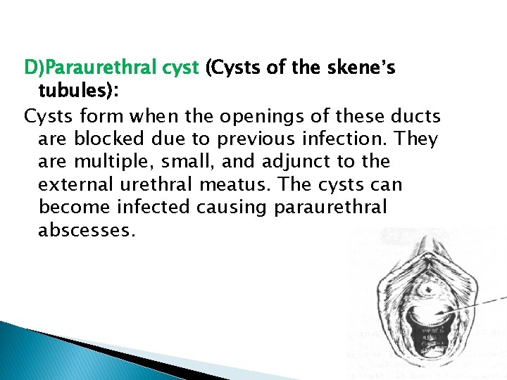 D)Paraurethral cyst (Cysts of the skene’s tubules): Cysts form when the openings of these