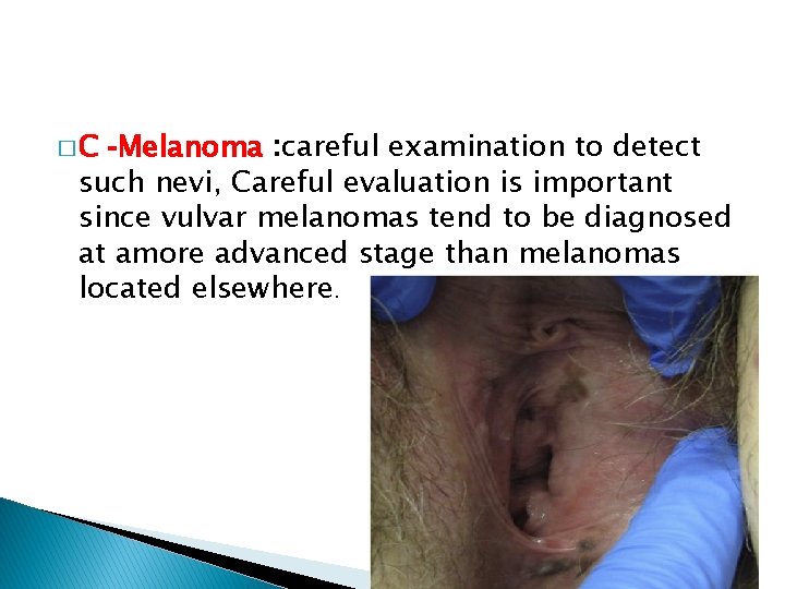 �C -Melanoma : careful examination to detect such nevi, Careful evaluation is important since