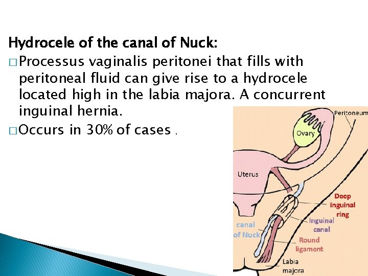 Hydrocele of the canal of Nuck: � Processus vaginalis peritonei that fills with peritoneal