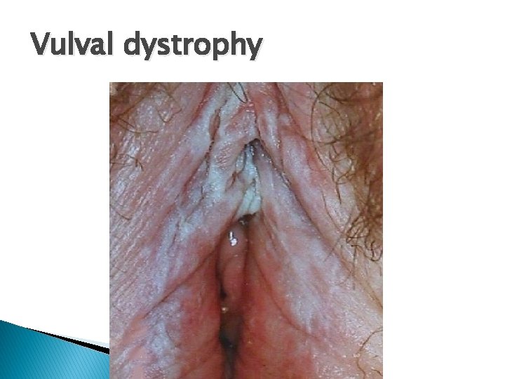 Vulval dystrophy 