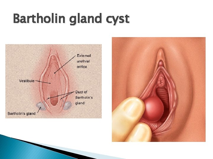 Bartholin gland cyst 