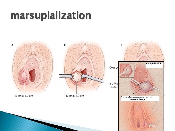 marsupialization 