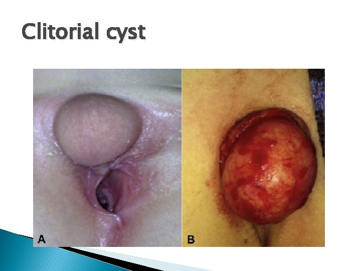 Clitorial cyst 