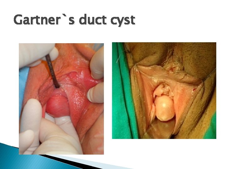 Gartner`s duct cyst 