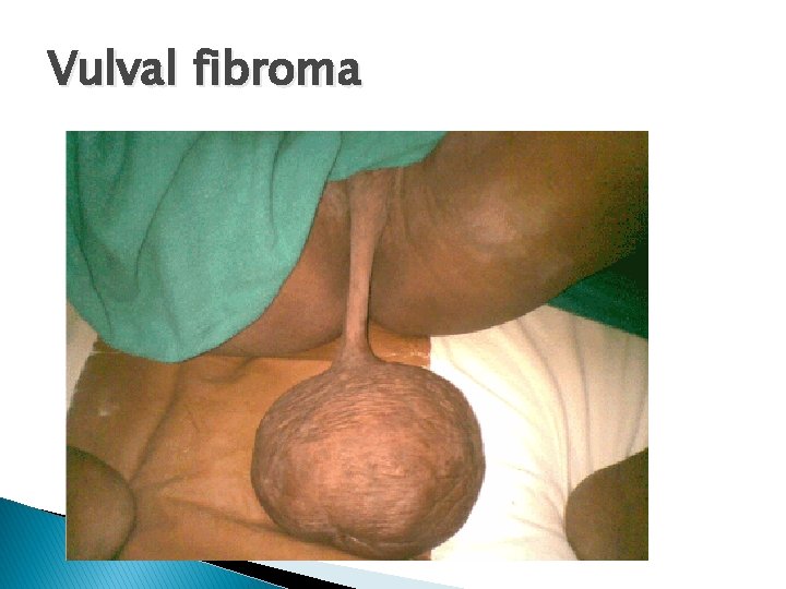 Vulval fibroma 