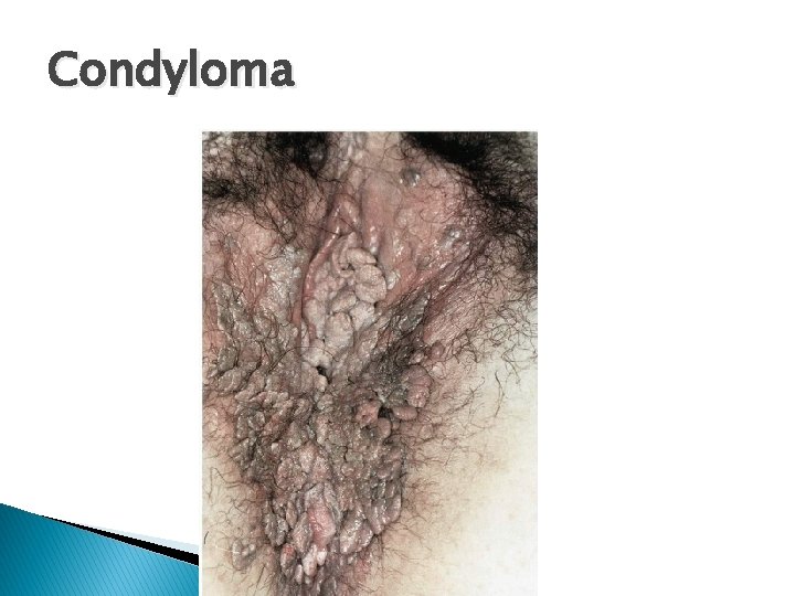 Condyloma 