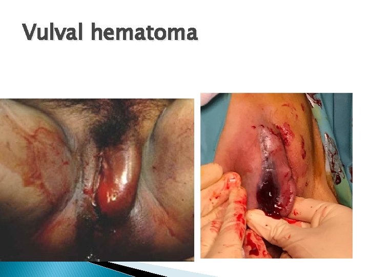 Vulval hematoma 