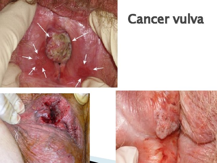 Cancer vulva 