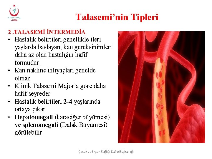 Talasemi’nin Tipleri 2. TALASEMİ İNTERMEDİA • Hastalık belirtileri genellikle ileri yaşlarda başlayan, kan gereksinimleri
