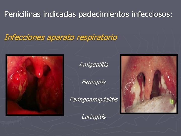 Penicilinas indicadas padecimientos infecciosos: Infecciones aparato respiratorio Amigdalitis Faringoamigdalitis Laringitis 