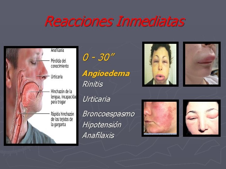 Reacciones Inmediatas 0 - 30” Angioedema Rinitis Urticaria Broncoespasmo Hipotensión Anafilaxis 