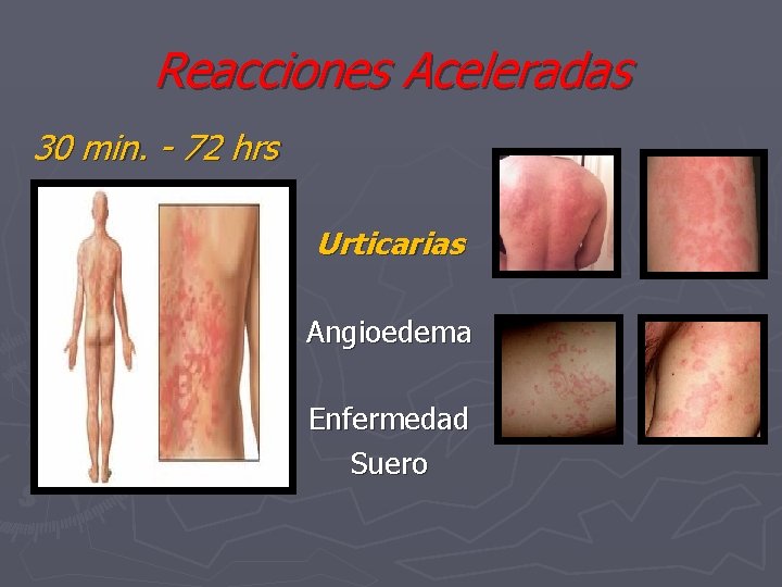 Reacciones Aceleradas 30 min. - 72 hrs Urticarias Angioedema Enfermedad Suero 