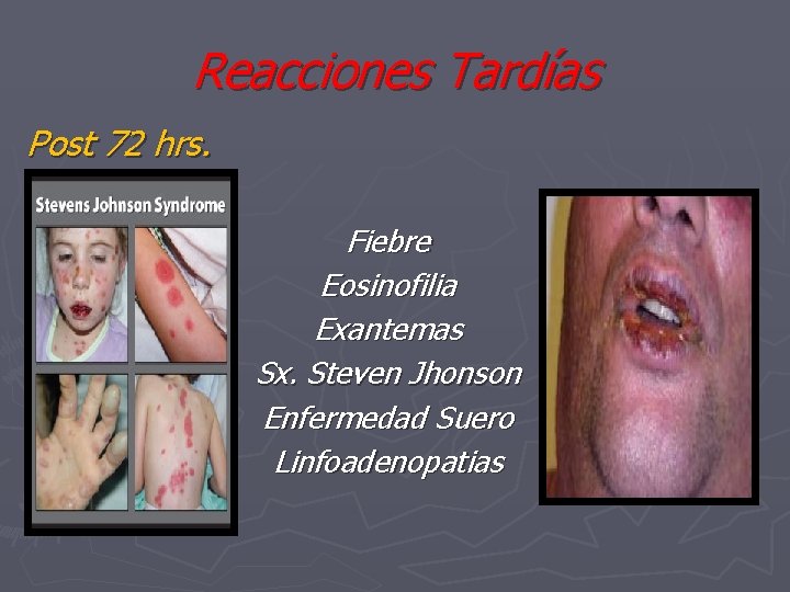 Reacciones Tardías Post 72 hrs. Fiebre Eosinofilia Exantemas Sx. Steven Jhonson Enfermedad Suero Linfoadenopatias