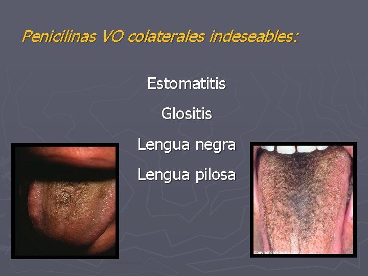 Penicilinas VO colaterales indeseables: Estomatitis Glositis Lengua negra Lengua pilosa 
