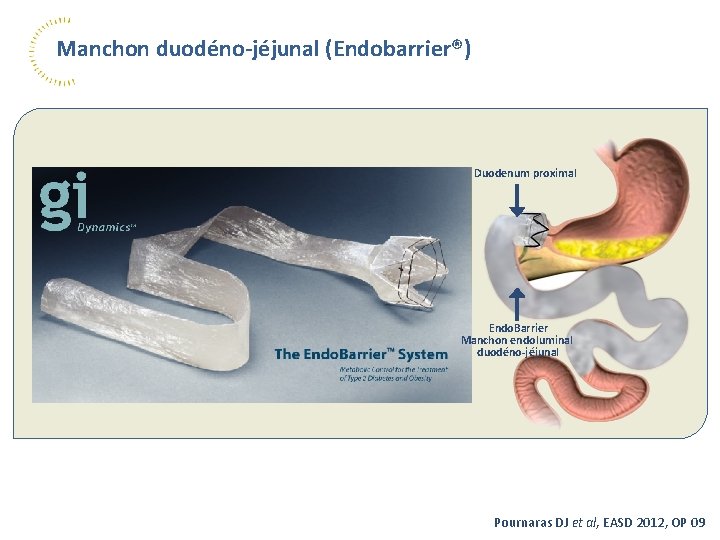 Manchon duodéno-jéjunal (Endobarrier®) Duodenum proximal Endo. Barrier Manchon endoluminal duodéno-jéjunal Pournaras DJ et al,