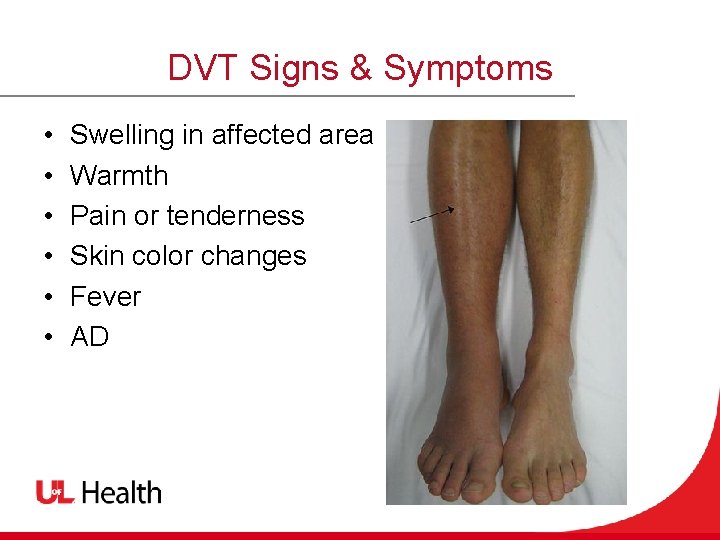 DVT Signs & Symptoms • • • Swelling in affected area Warmth Pain or